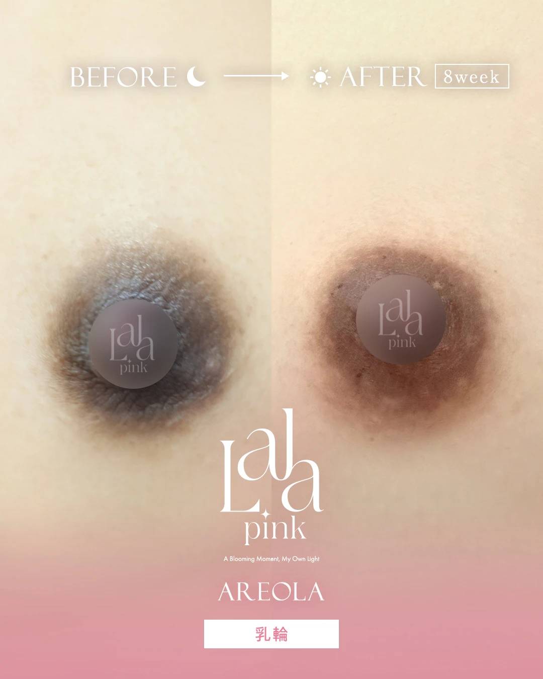 ララピンク症例2