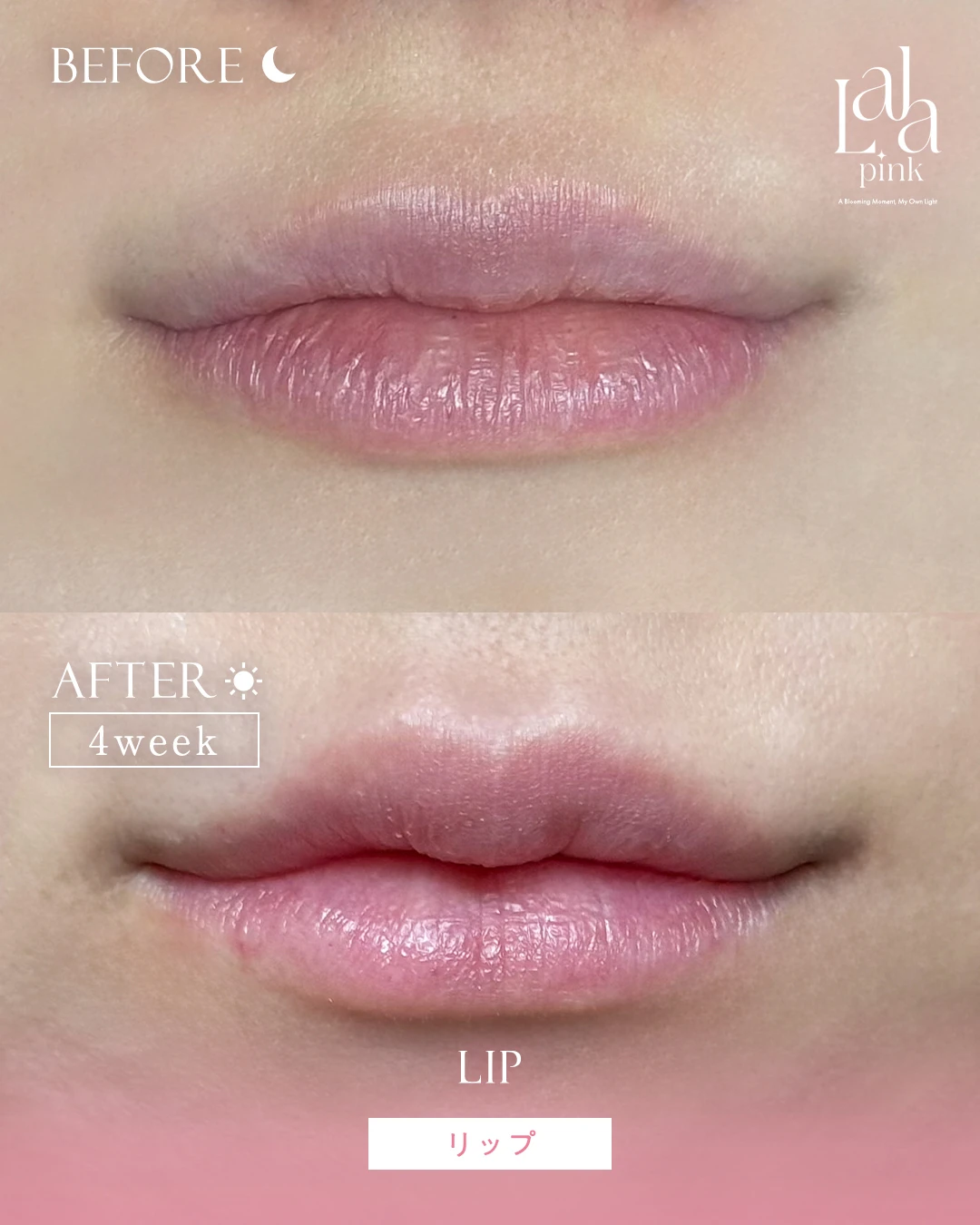 ララピンク症例3