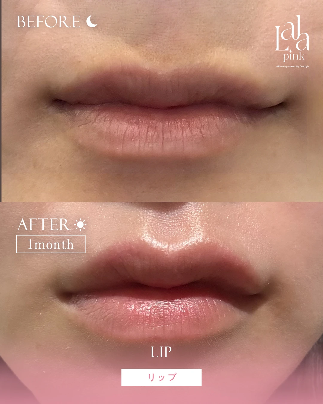 ララピンク症例4