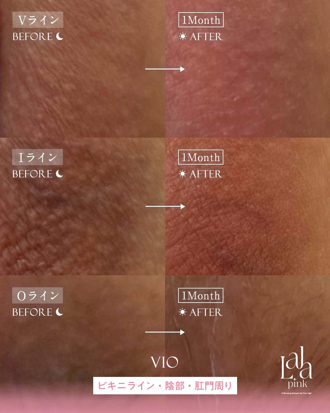 ララピンク症例5