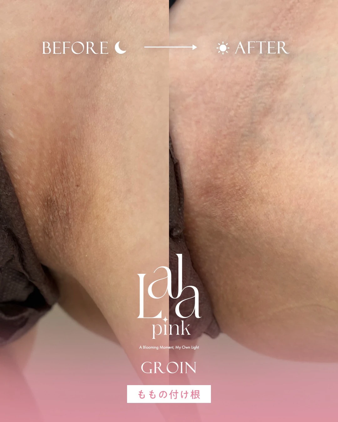 ララピンク症例6