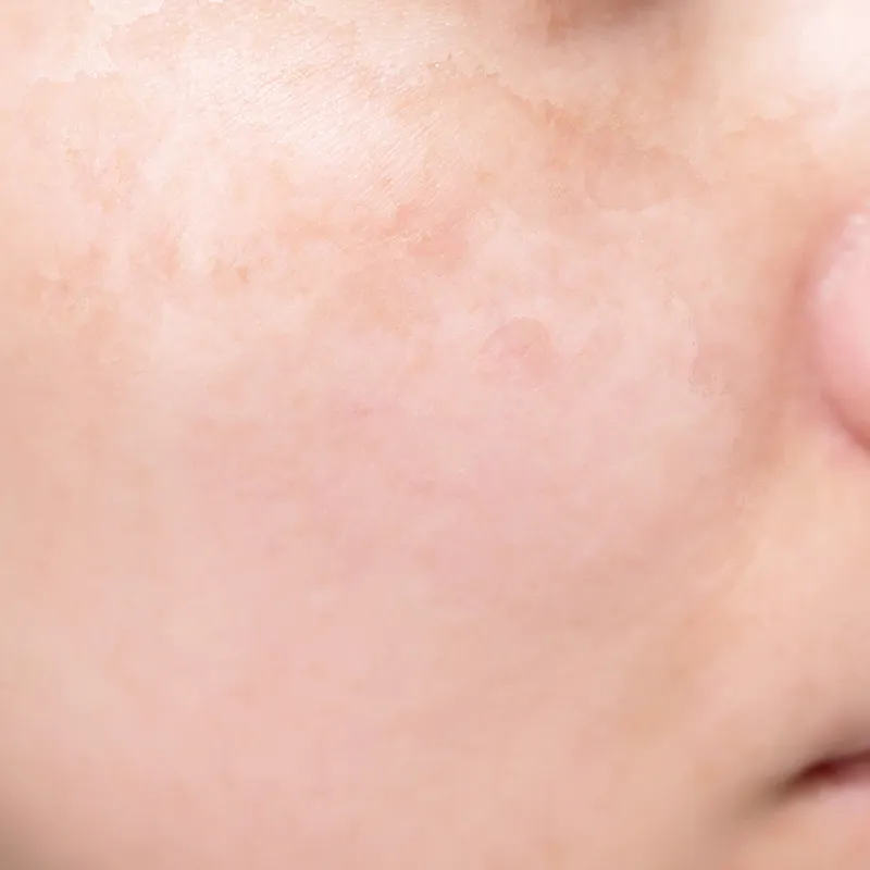 頬骨周辺に広がるタイプ