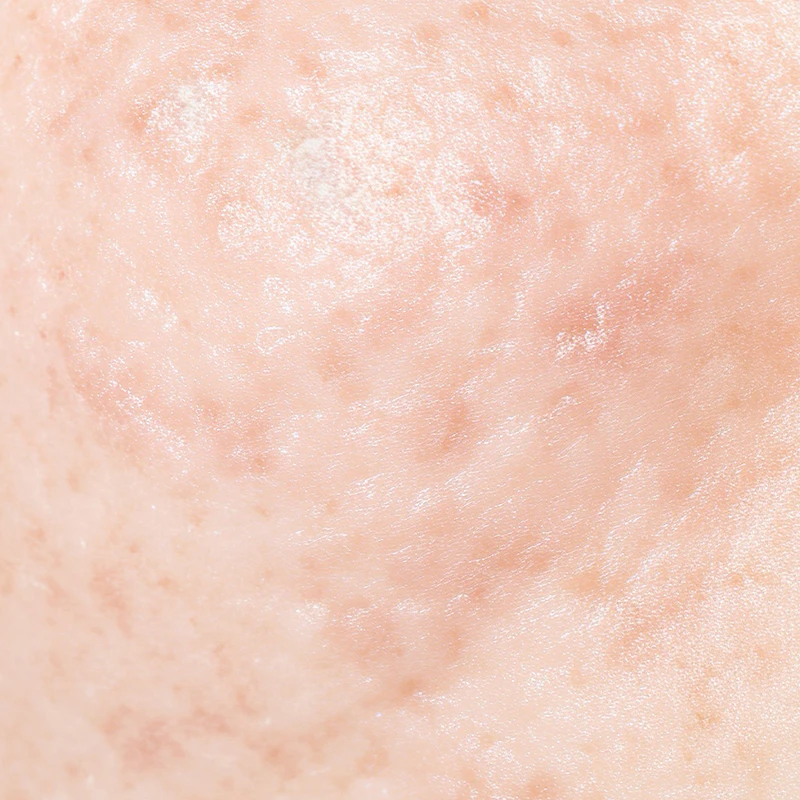 クレータータイプ　実例