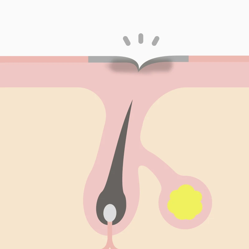 色素沈着タイプ