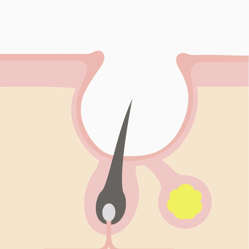 クレータータイプ