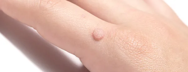 いぼ治療とは？