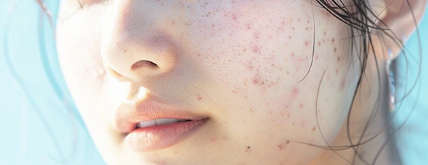 ニキビ跡治療とは？