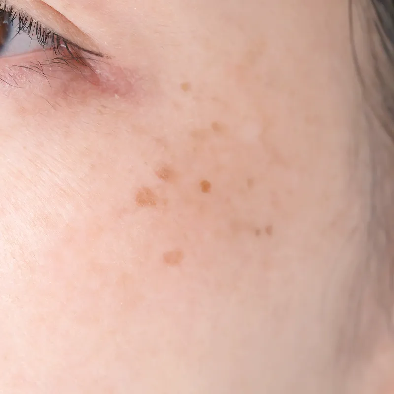 老人性色素斑（日光黒子）