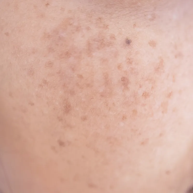 ADM（後天性真皮メラノサイトーシス）