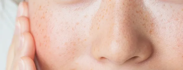 そばかす治療とは？