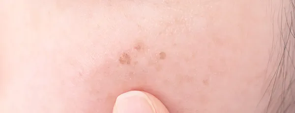 シミ治療とは？