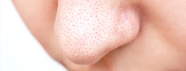 毛穴治療とは？