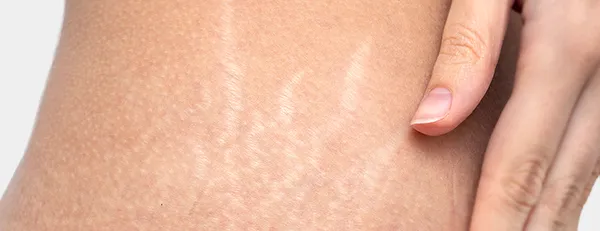 肉割れ治療とは？